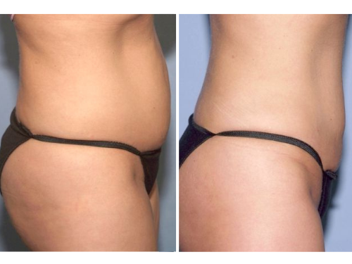 ANTI-CELLULITE TREATMENT