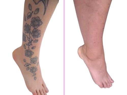 laser tattoo removal